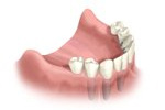 Installing Dental Implants Image