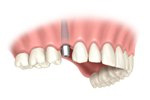 Installing dental implants