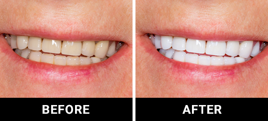 Porcelain Veneers before and After