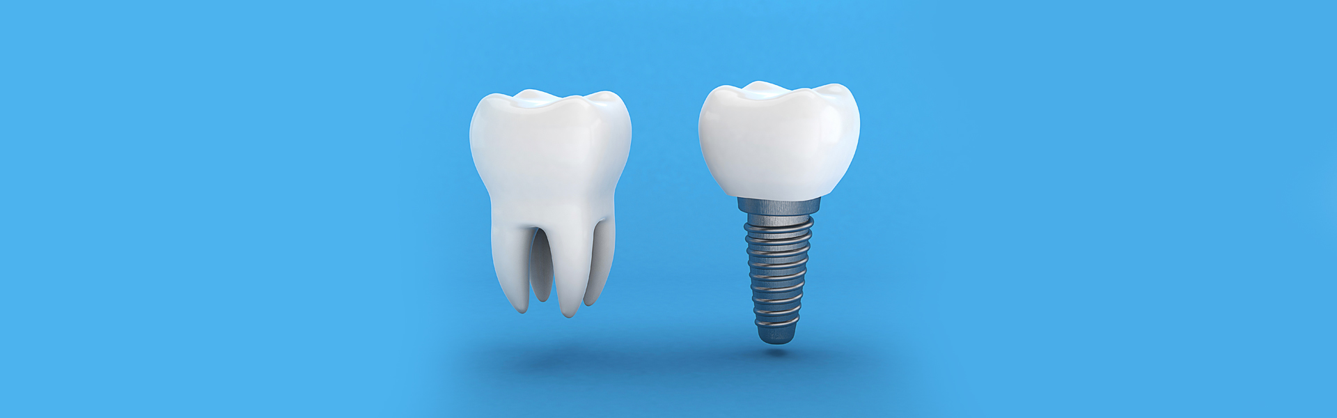What Are the Problems With All-On-4 Dental Implants?