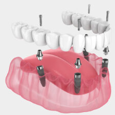 How Is All-on-4® Different from Traditional Dental Implants?