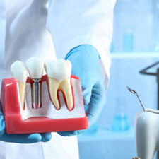 Can You Replace an Extracted Tooth with an Implant?