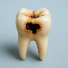 Say Goodbye to Cavities: How Dental Fillings Restore & Protect Your Smile