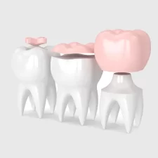 How to Care for Your Inlay/Onlay — Brushing, Flossing, Checkups, Avoiding Damaging Habits