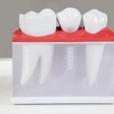 What Are the Benefits of Dental Implants for Seniors in Talent Dental, Rancho Cucamonga, CA?