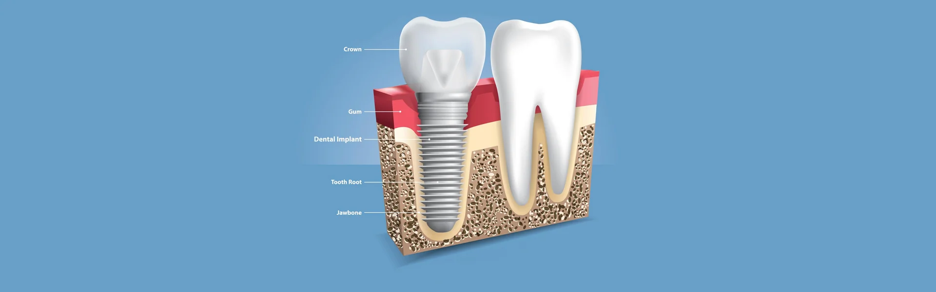 Tooth replacement options
