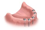 photo of after dental treatment