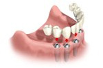 Attaching dental bridge image